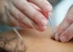 Add Some Needle To Your Digital Sleeve With Acupuncture SEO Services