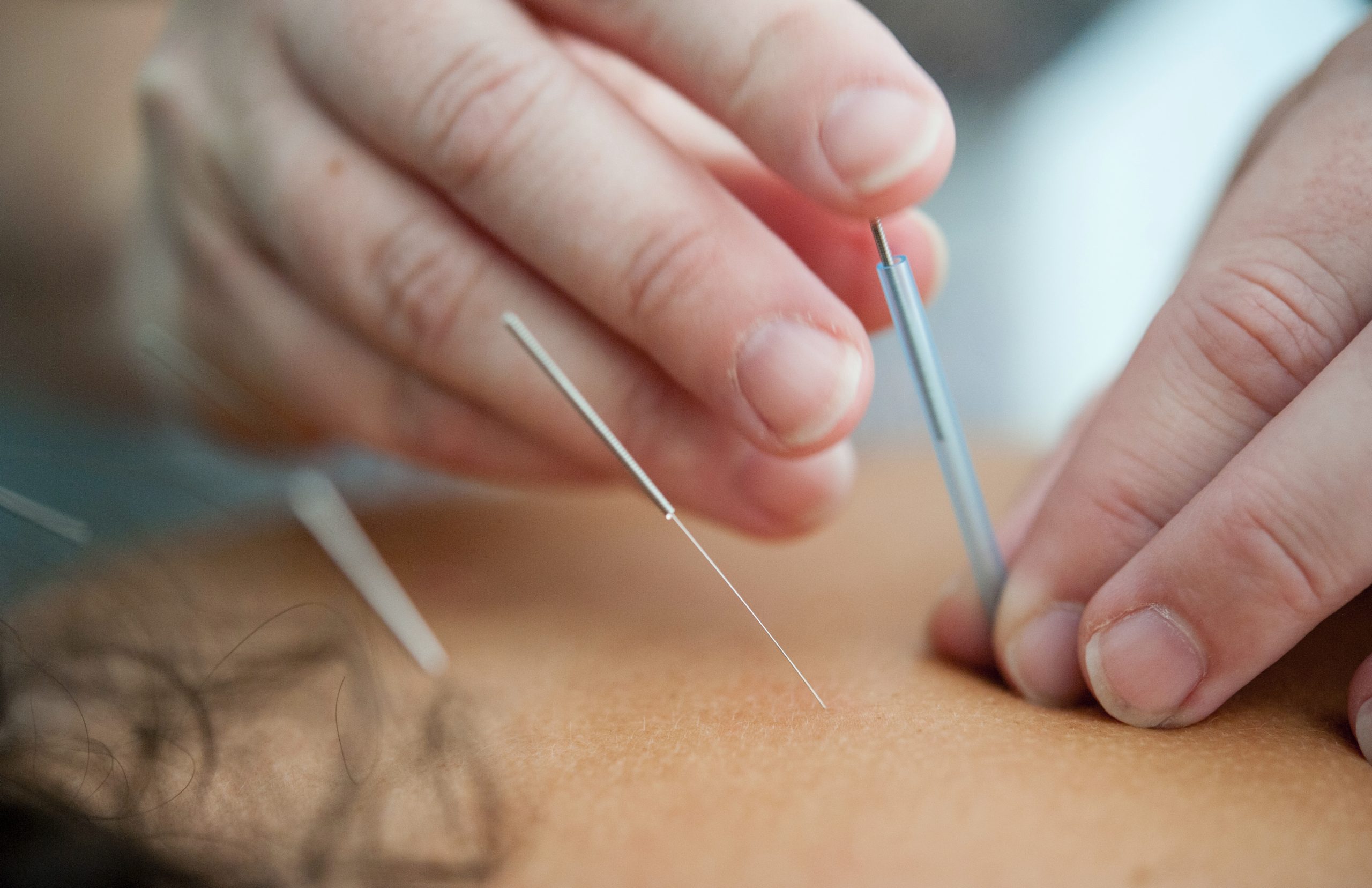 Add Some Needle To Your Digital Sleeve With Acupuncture SEO Services